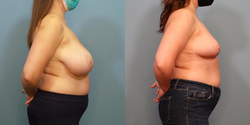 Photo of a woman before and after breast reduction surgery with internal bra.