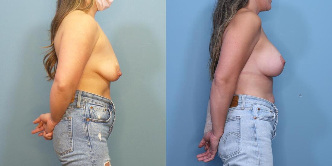 Photo of a woman before and after a single stage augmentation mastopexy with double internal bra and mesh.