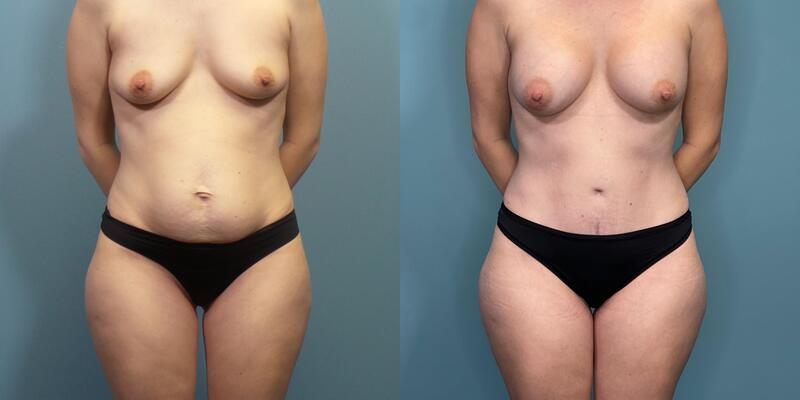 Photo of a woman before and after a tummy tuck, breast augmentation and neoumbilicoplasty.