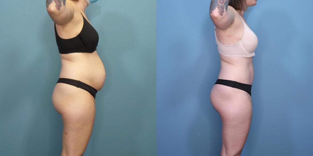 Photo of a woman before and after a tummy tuck with neoumbilicoplasty.