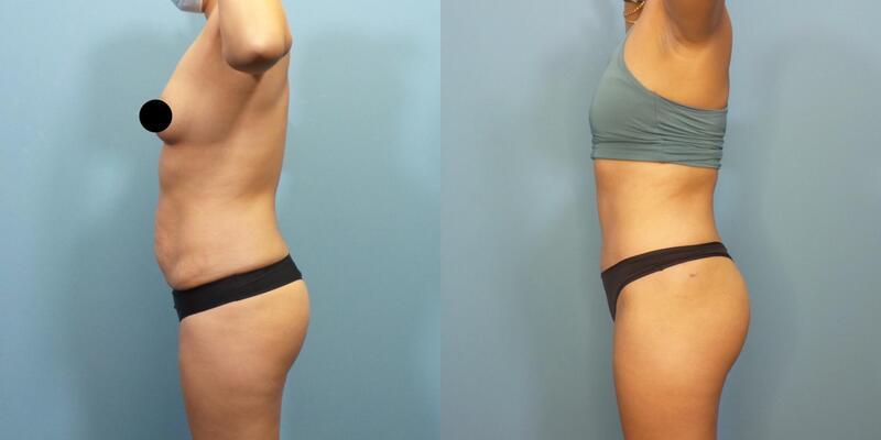 Photo of a woman before and after an extended tummy tuck with lower abdominal and flank liposuction.
