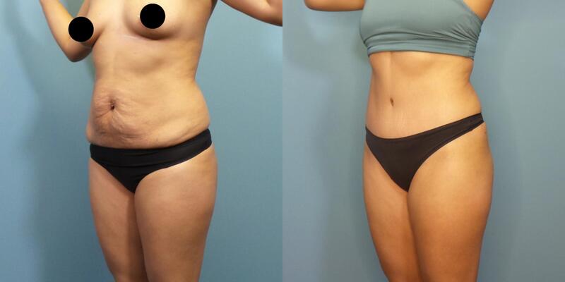 Photo of a woman before and after an extended tummy tuck with lower abdominal and flank liposuction.