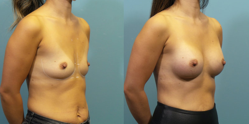Photo of a woman before and after breast augmentation surgery. 