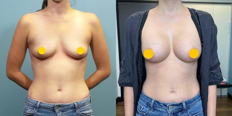 Photo of a woman before and after breast augmentation surgery. 