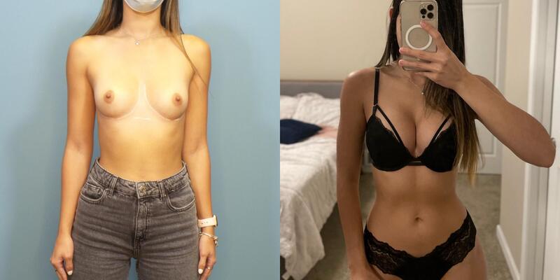 Photo of a woman before and after breast augmentation with Sientra Silicone Breast Implants.
