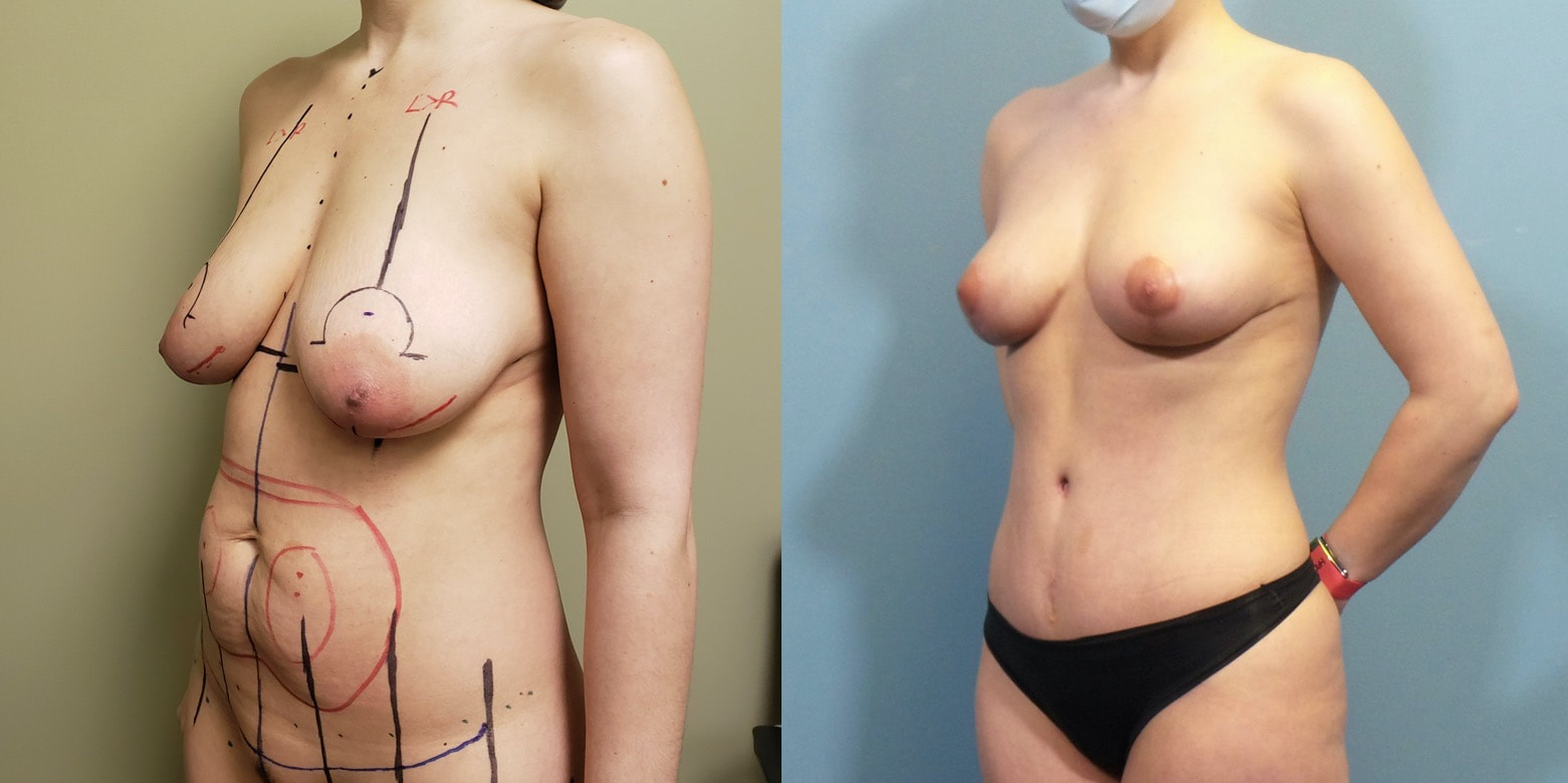 Photo of a woman before and after a tummy tuck and breast lift.