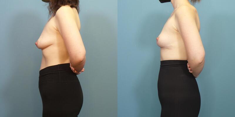 Photo of a woman before and after breast lift surgery with internal bra.