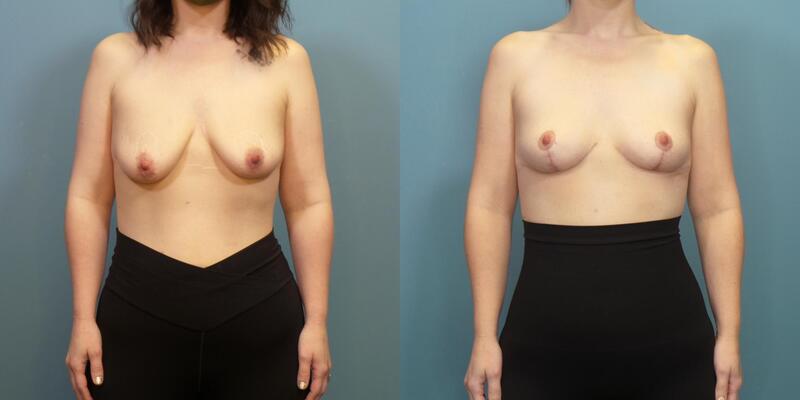 Photo of a woman before and after breast lift surgery with internal bra.