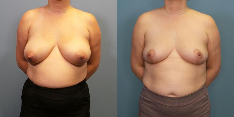 Photo of a woman before and after breast reduction surgery.