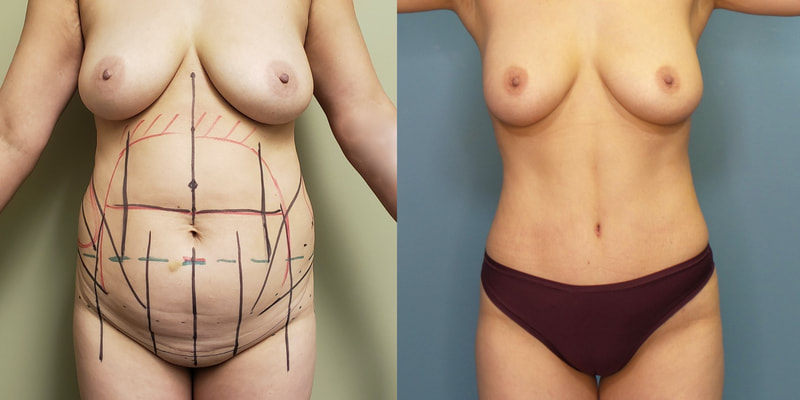 Photo of a woman before and after lipo 360, abdominoplasty and BBL.