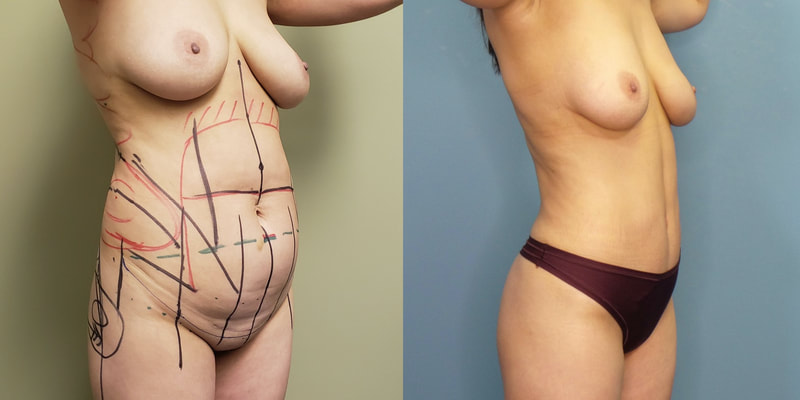 Photo of a woman before and after lipo 360, abdominoplasty and BBL.