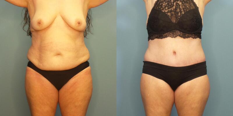 Photo of a woman before and after lipo 360 and 270 degree abdominoplasty.