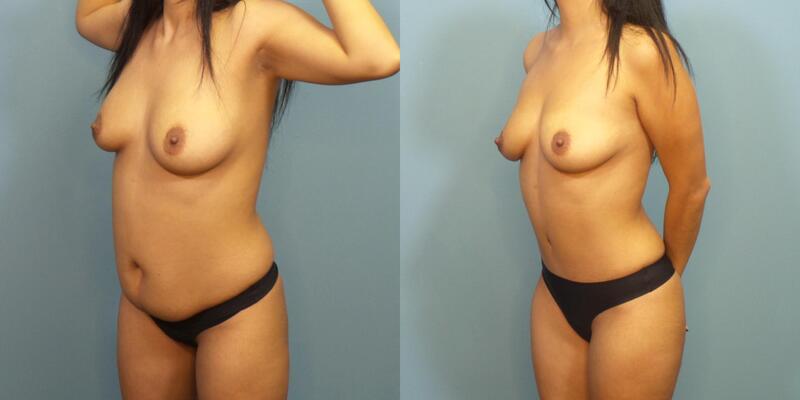 Photo of a woman before and after lipo 360 and an abdominoplasty.