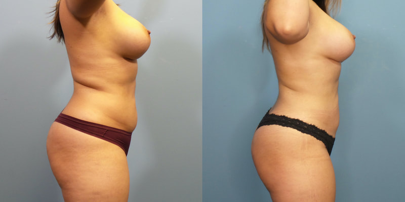 Photo of a woman before and after lipo 360.