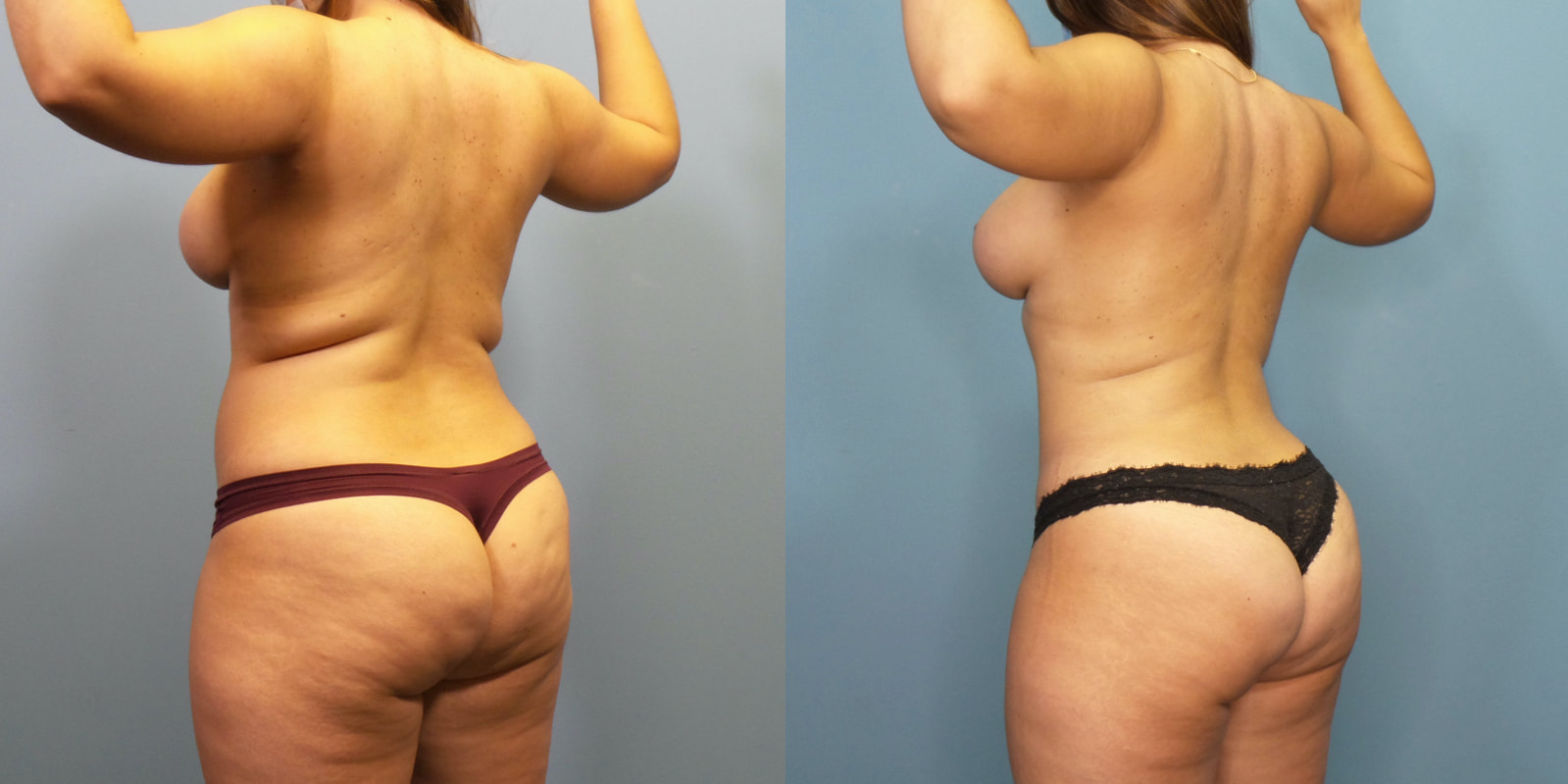 Photo of a woman before and after lipo 360.