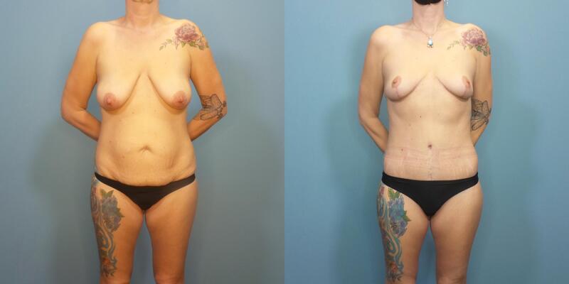 Photo of a woman before and after mommy makeoever with 270 degree tummy tuck and breast lift.