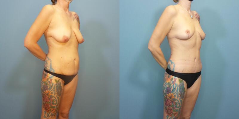 Photo of a woman before and after mommy makeoever with 270 degree tummy tuck and breast lift.