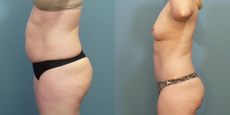 Photo of a woman before and after tummy tuck surgery. 