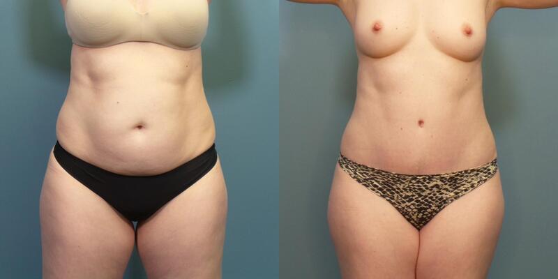 Photo of a woman before and after tummy tuck surgery. 