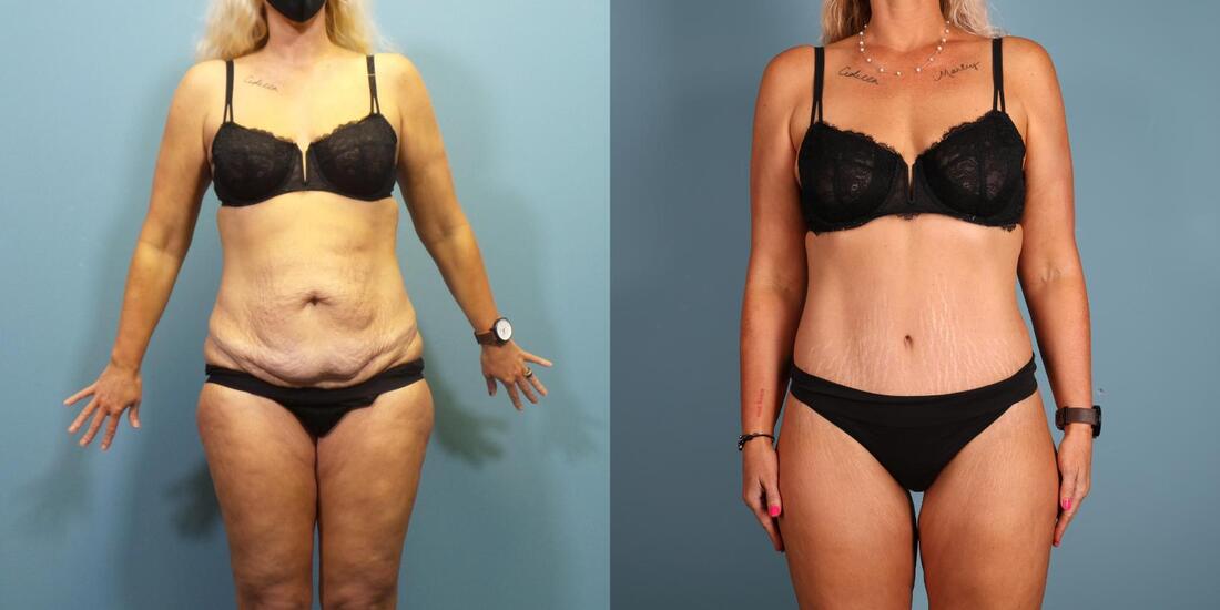 Photo of a woman before and five months after a 270 degree tummy tuck.