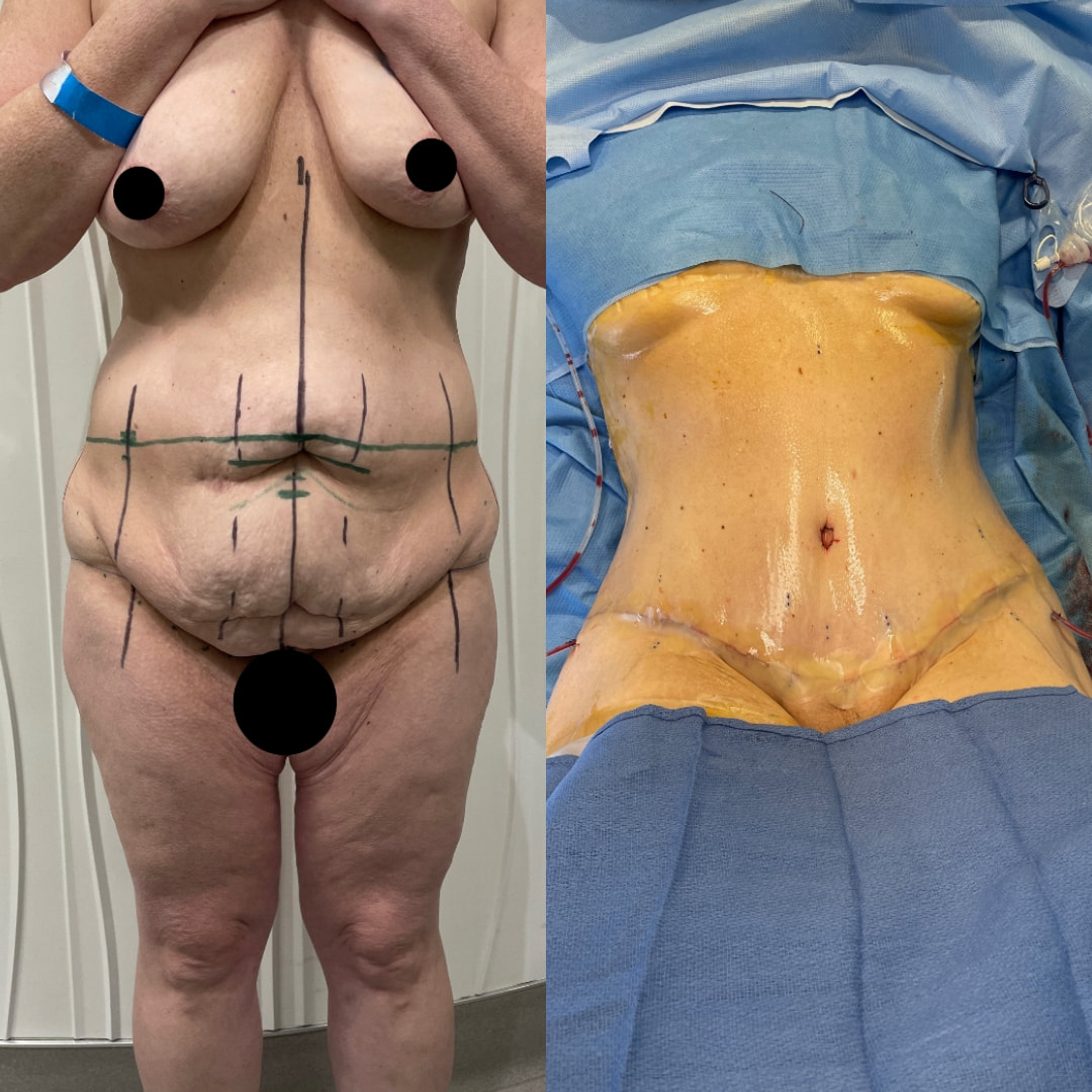 This is a picture of a woman before and after a tummy tuck. 