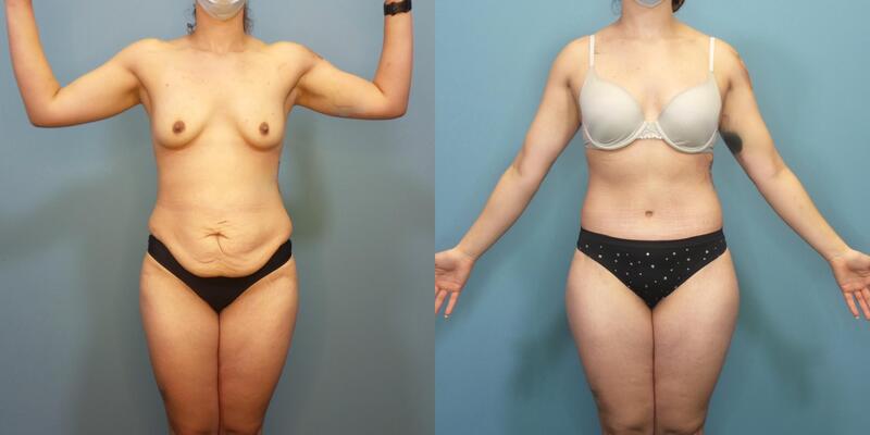 Photo of a woman before and two and a half months after a lower body lift.