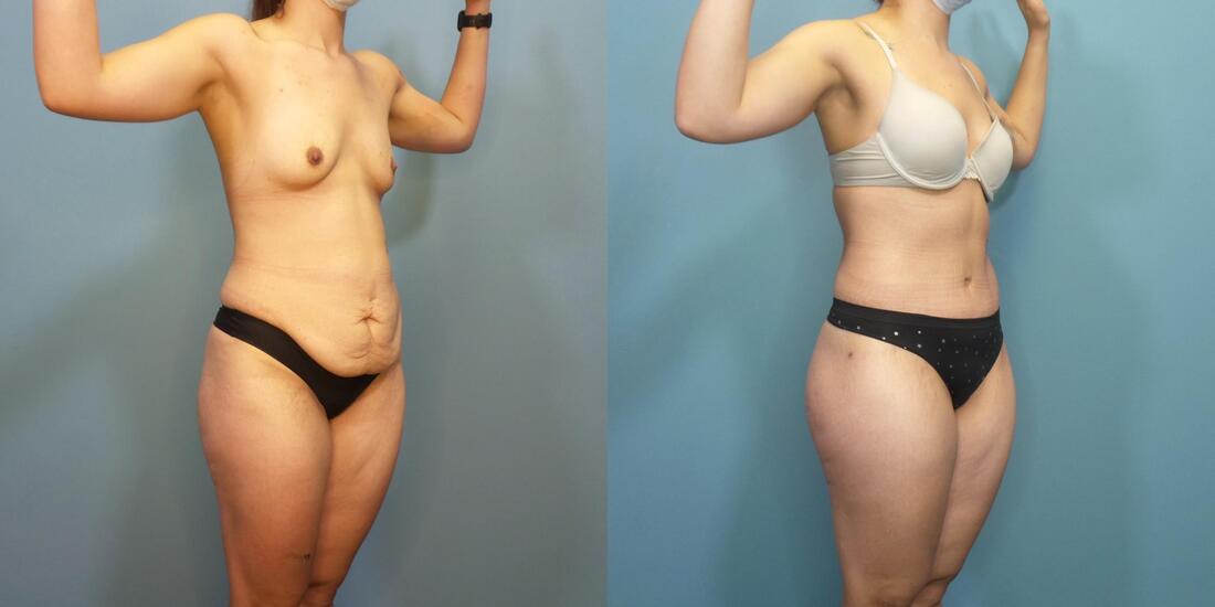 https://www.drhayescosmeticsurgery.com/uploads/6/9/2/9/69297503/photo-of-a-woman-before-and-two-and-a-half-months-after-a-lower-body-lift-d_orig.jpeg