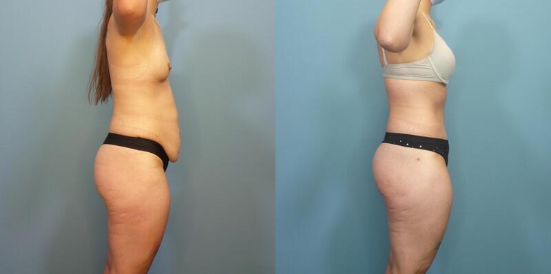 Photo of a woman before and two and a half months after a lower body lift.