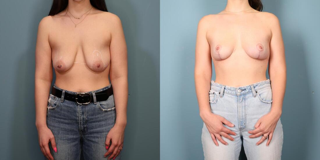 This is a photo of a woman before and after a breast lift. 