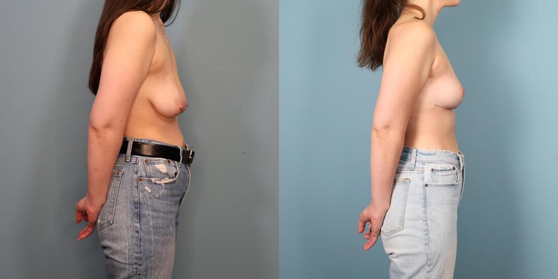 Photo of a woman before and two months after a double bra breast lift.