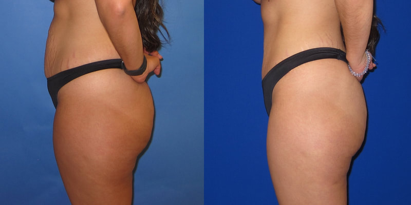 Photo of a woman before and after an abdominoplasty.