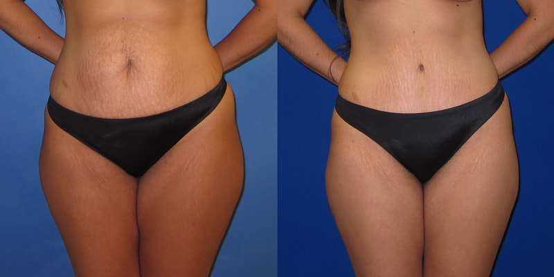 Photo of a woman before and after an abdominoplasty.