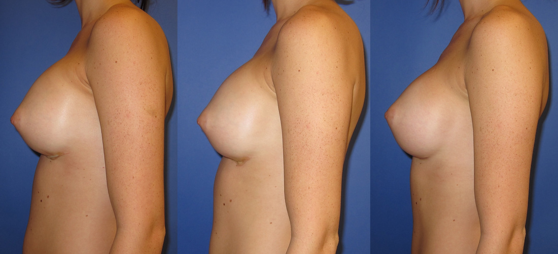 Implants settling after breast augmentation surgery. This is called 
